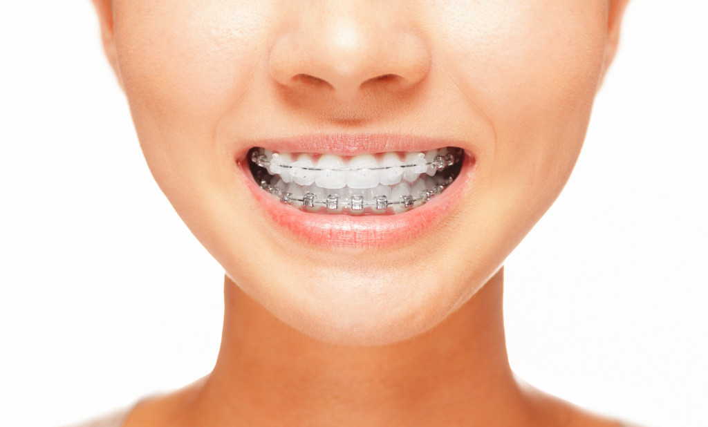 woman's teeth with braces